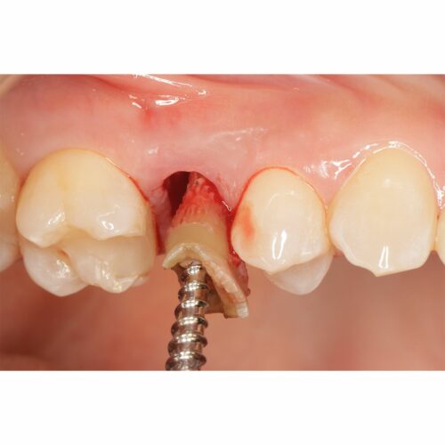 screw going into teeth